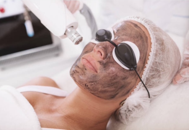 Carbon Peel